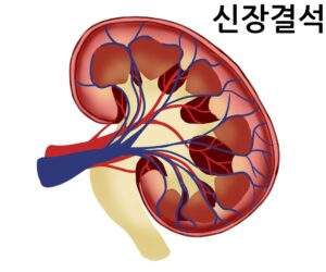 신장결석